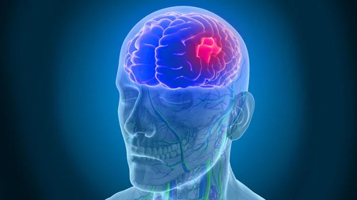 علائم سکته مغزی چیست ؟