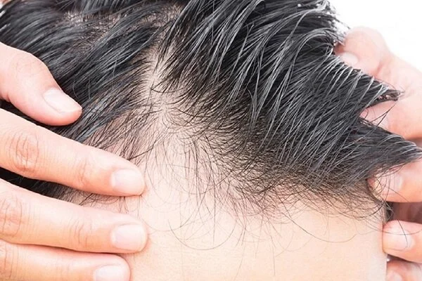 بهترین روشها برای درمان شقیقههای کممو چیست؟ بهترین روشها برای درمان شقیقههای کممو چیست؟