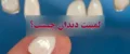 لمینت دندان چیست؟ | قیمت لمینت ۱۴۰۴، مزایا و معایب
