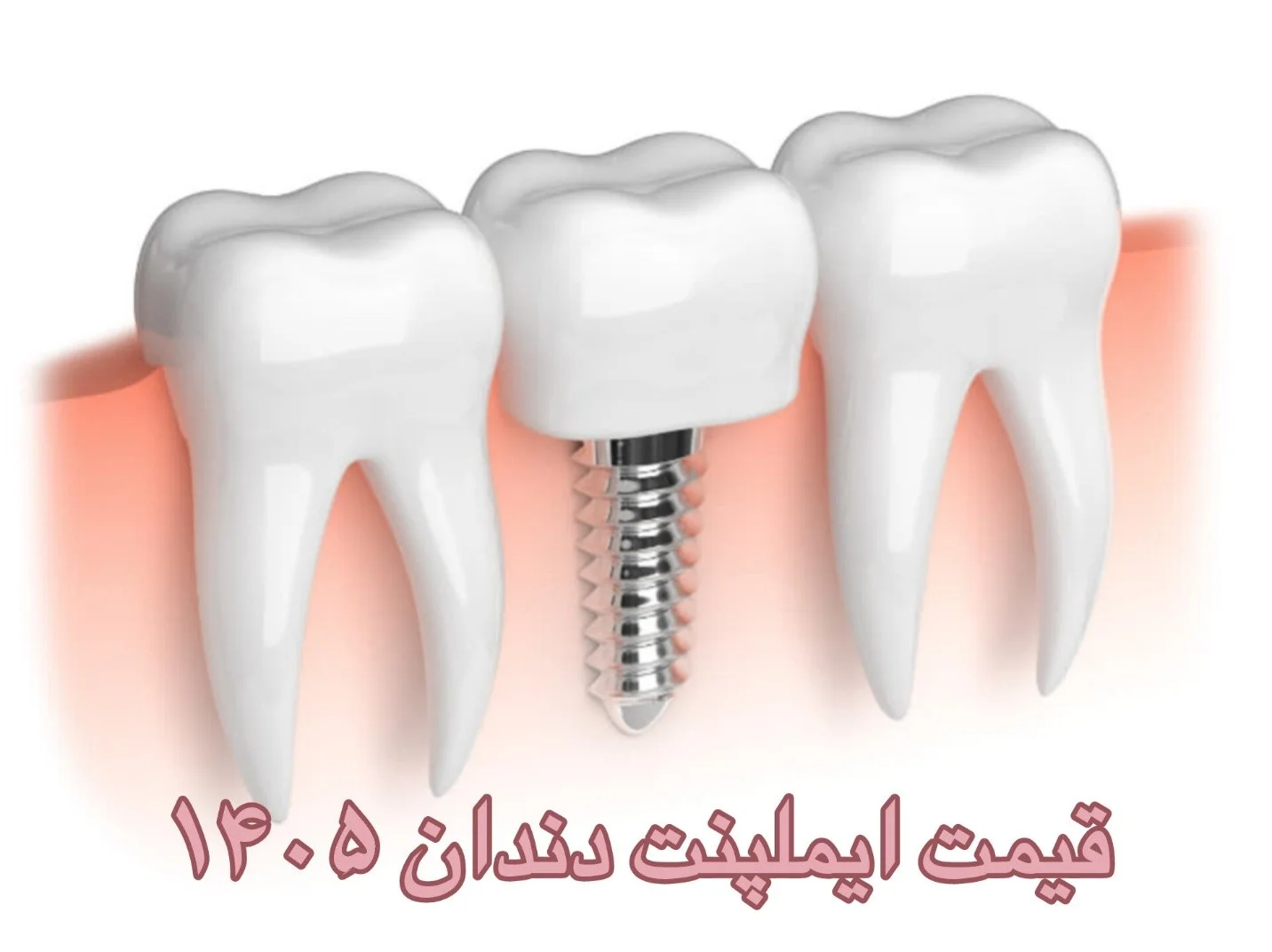 قیمت ایمپلنت دندان ۱۴۰۵