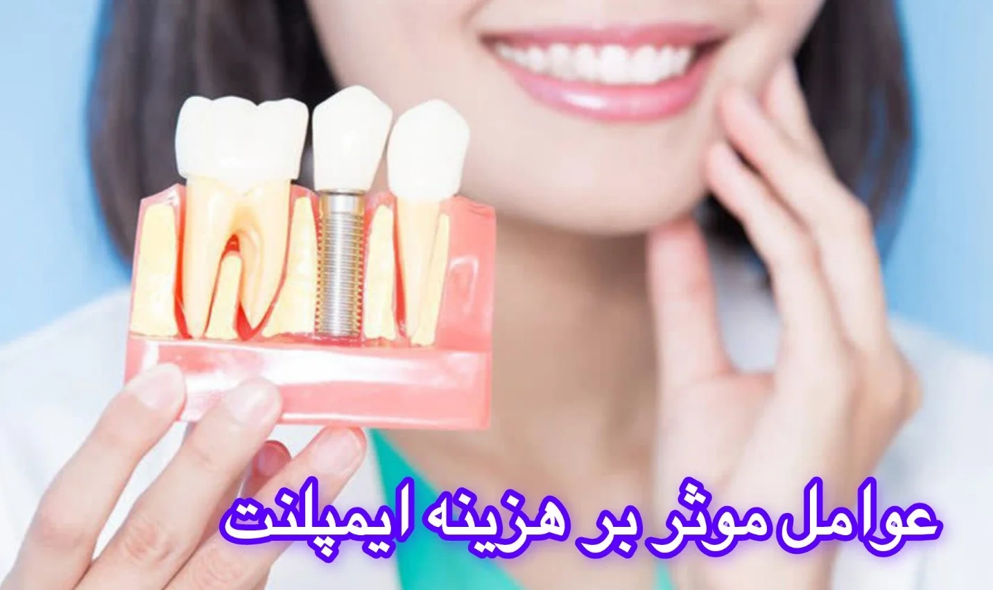 هزینه ایمپلنت دندان در تهران