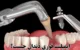 ایمپلنت یک روزه چیست؟ + قیمت ایمپلنت فوری در تهران 1405