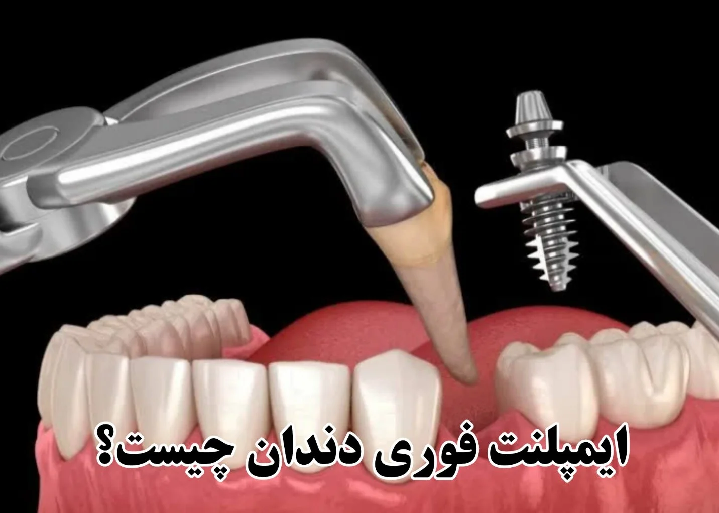 ایمپلنت یک روزه چیست؟ + قیمت ایمپلنت فوری در تهران 1405